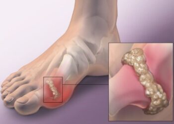 Giải pháp khoa học hỗ trợ điều trị bệnh Gout không dùng thuốc